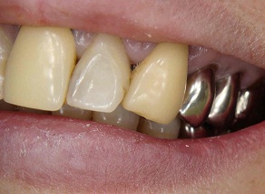 ジルコニア症例42「笑うと気になる銀歯を…」