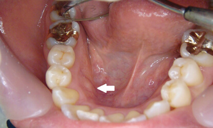 歯ぎしりをする人の口の中の状態